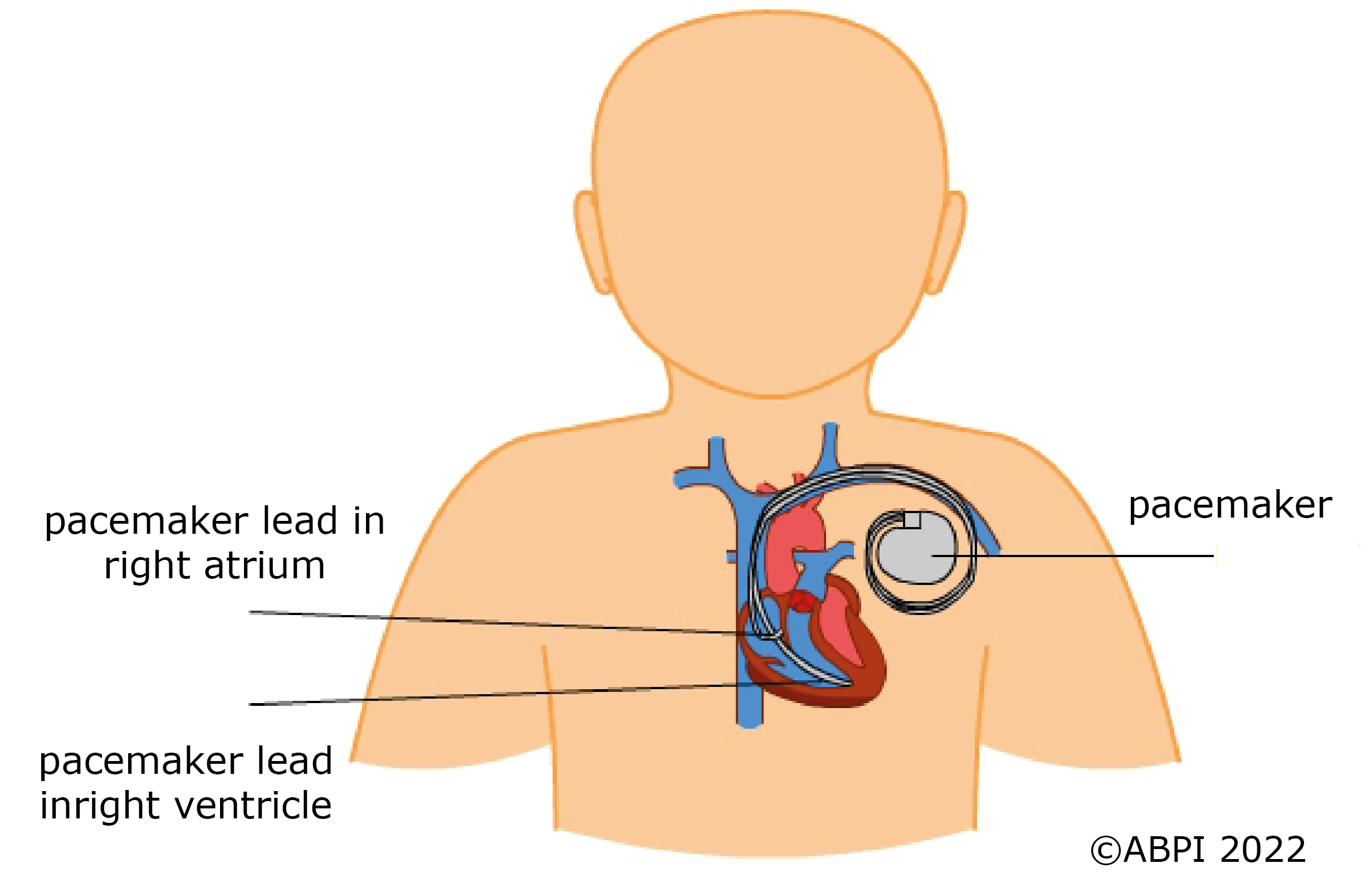 Pacemaker New