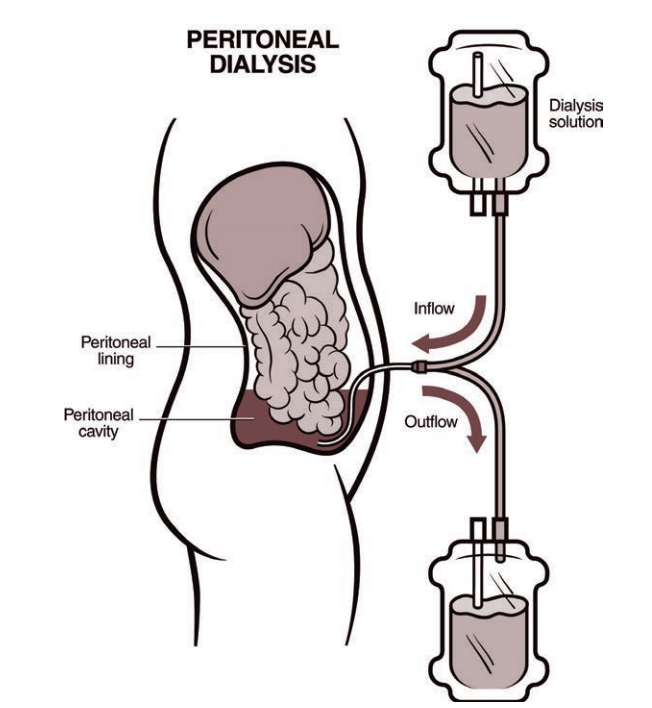 Peritoneal Dialysis