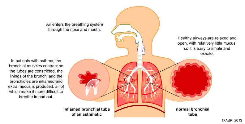 Bronch In Astham Attacks Copy