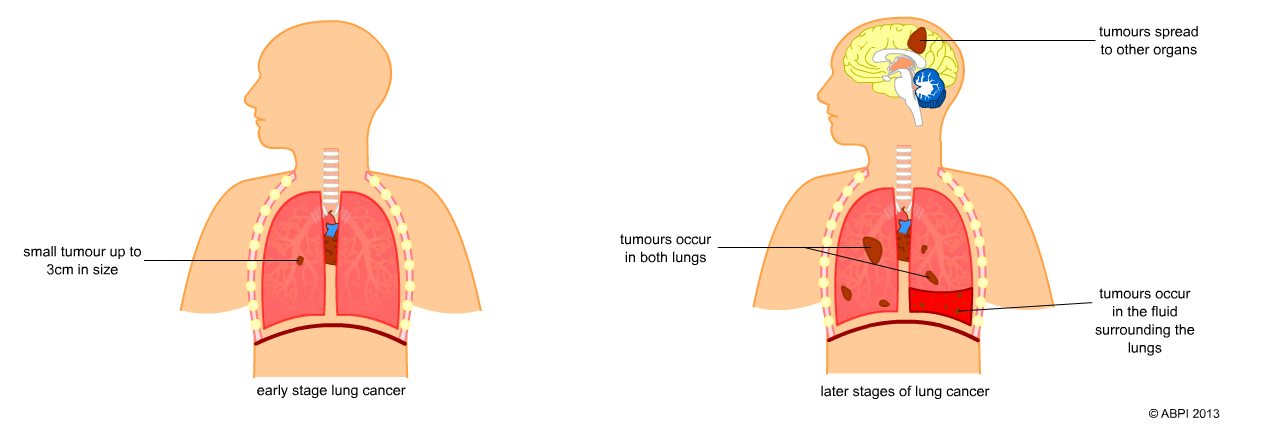 Lung Cancer Development